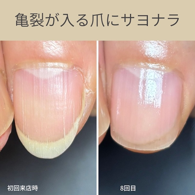 富津市ネイルサロン｜深爪・噛み爪・むしり爪でお悩みならMi dia｜ミディア